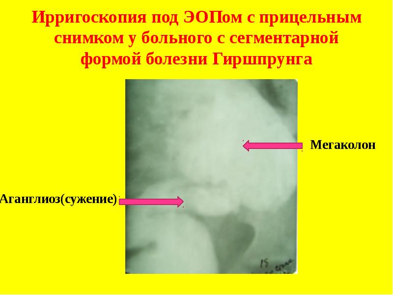 Схема изменений толстой кишки при болезни гиршпрунга