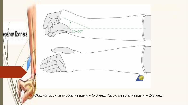 Перелом колеса и смита презентация