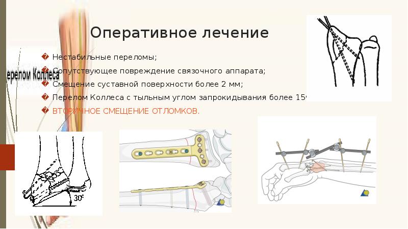 Перелом колеса и смита презентация