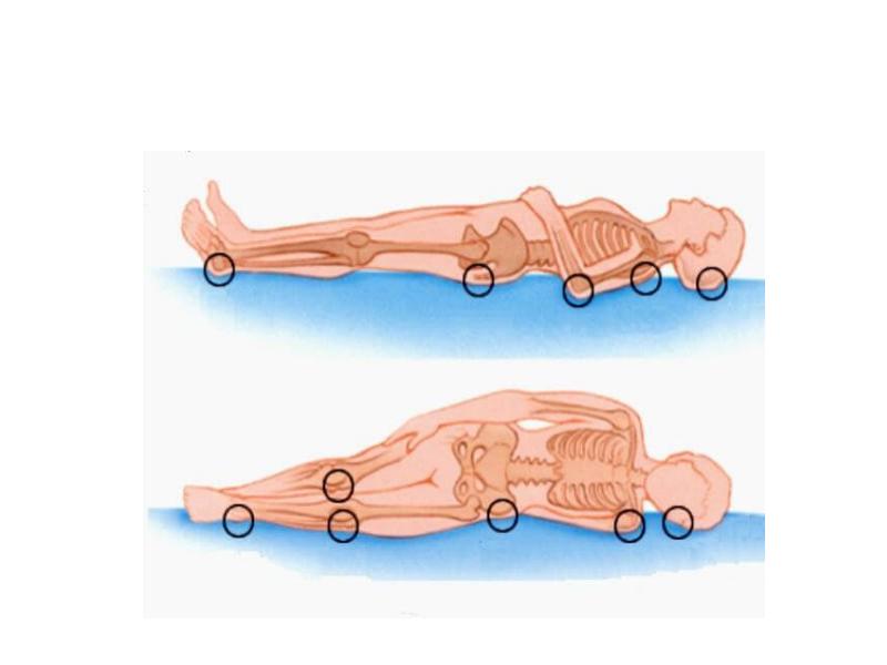 Места образования пролежней картинки