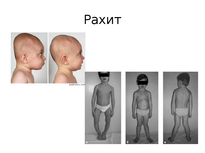 Презентация по педиатрии рахит