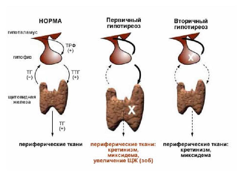Аплазия щитовидной железы. Врожденный первичный гипотиреоз. Первичные и вторичные заболевания щитовидной железы. Первичный вторичный третичный гипотиреоз. Классификация гипофункции щитовидной железы.
