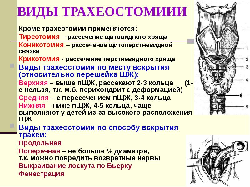 Трахеостомия техника выполнения в картинках для детей