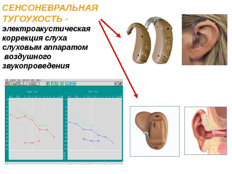 Операция на ухо на слух