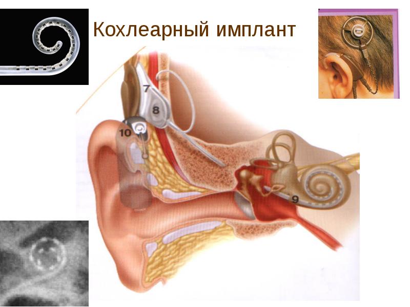 Болезнь меньера картинки