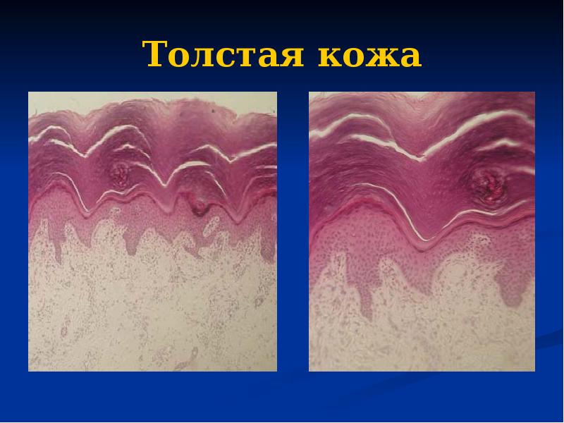 Толстая кожа