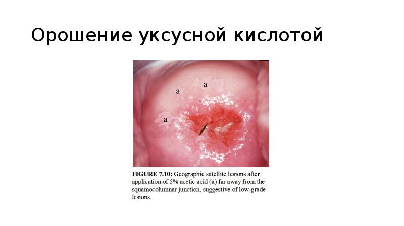 Орошение уксусной кислотой Орошение уксусной кислотой