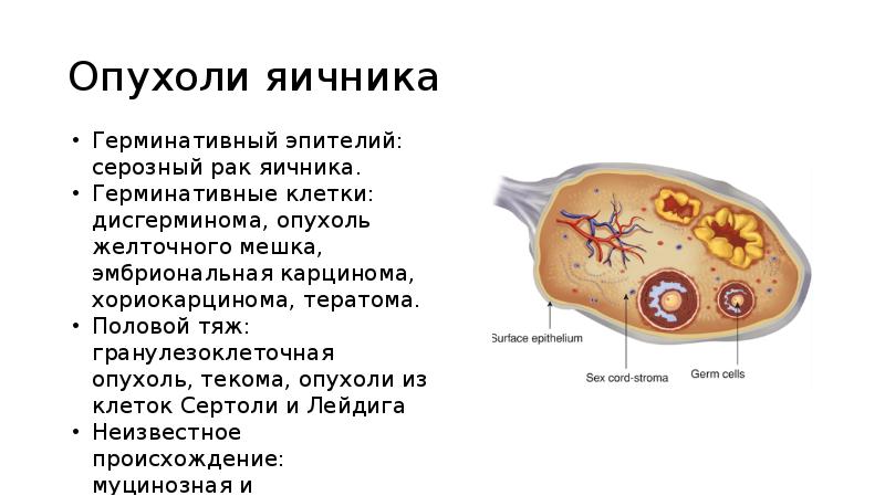 Опухоли яичника Опухоли яичника