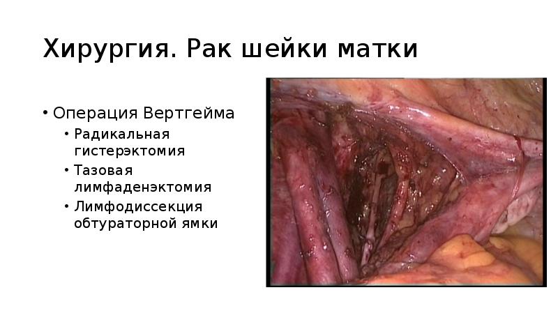 Хирургия. Рак шейки матки
Операция Вертгейма
Радикальная гистерэктомия
Тазовая лимфаденэктомия
Лимфодиссекция Хирургия. Рак шейки матки
Операция Вертгейма
Радикальная гистерэктомия
Тазовая лимфаденэктомия
Лимфодиссекция
