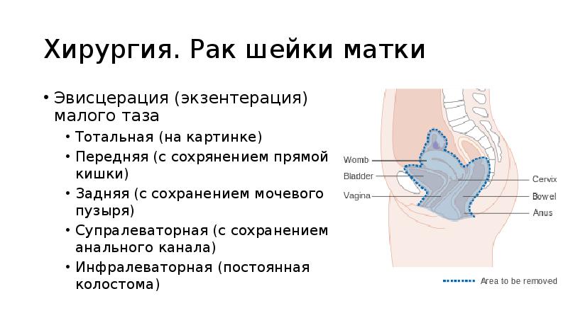 Хирургия. Рак шейки матки
Эвисцерация (экзентерация) малого таза
Тотальная (на картинке)
Хирургия. Рак шейки матки
Эвисцерация (экзентерация) малого таза
Тотальная (на картинке)