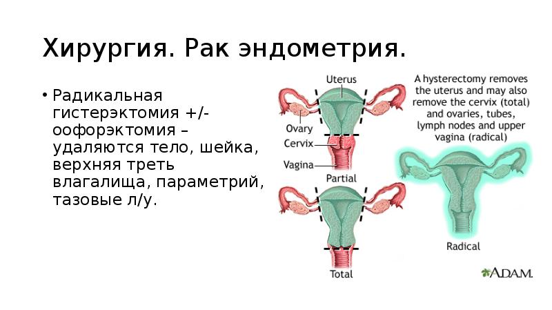 Хирургия. Рак эндометрия.
Радикальная гистерэктомия +/- оофорэктомия – удаляются тело, Хирургия. Рак эндометрия.
Радикальная гистерэктомия +/- оофорэктомия – удаляются тело,