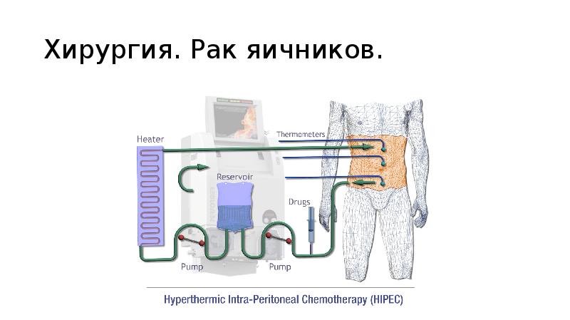 Хирургия. Рак яичников. Хирургия. Рак яичников.