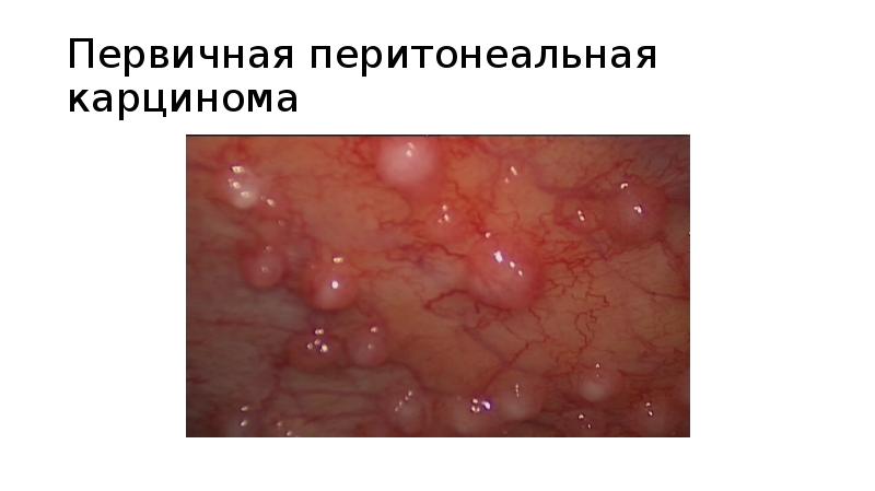 Первичная перитонеальная карцинома Первичная перитонеальная карцинома