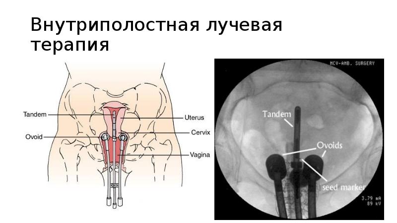 Внутриполостная лучевая терапия Внутриполостная лучевая терапия