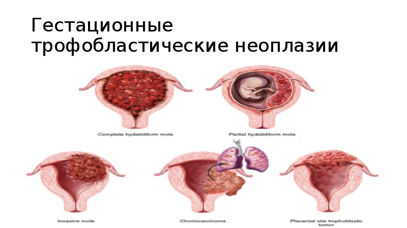 Гестационные трофобластические неоплазии Гестационные трофобластические неоплазии