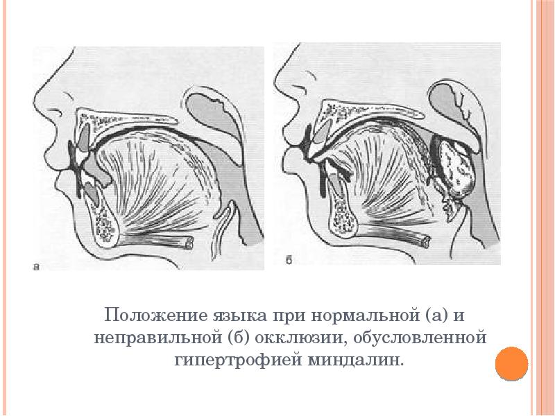 Мюинг положение языка схема