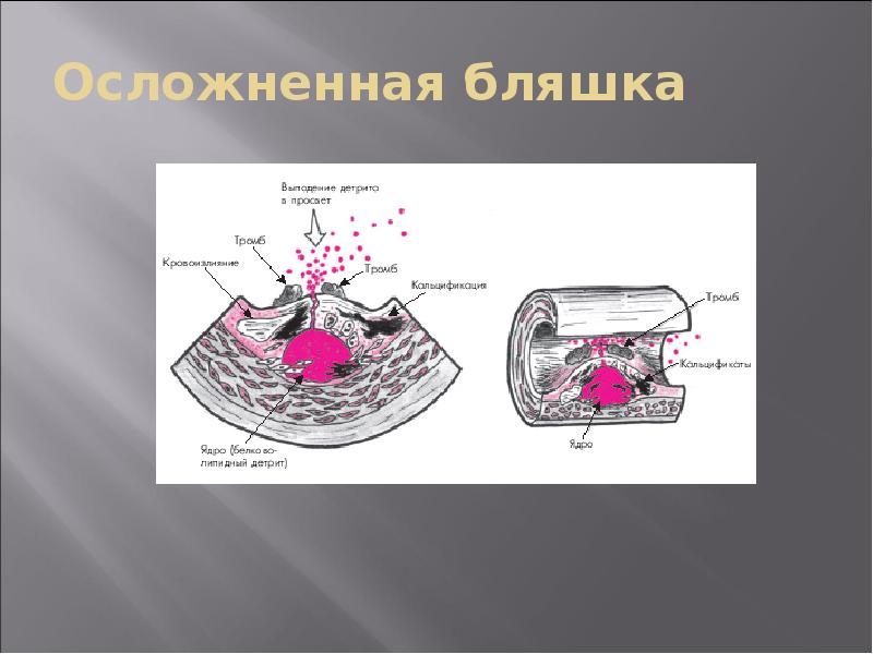 Патофизиология атеросклероза презентация