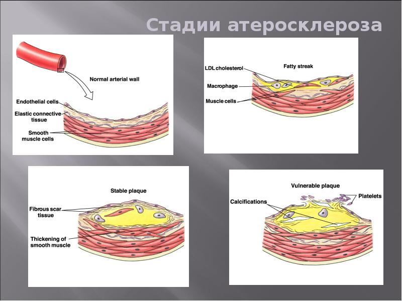 Атеросклероз анатомия. Атеросклероз периоды развития. Патогенез атеросклероза Долипидная стадия. Стадии развития атеросклероза патанатомия. Атеросклероз Долипидная стадии патанатомия.