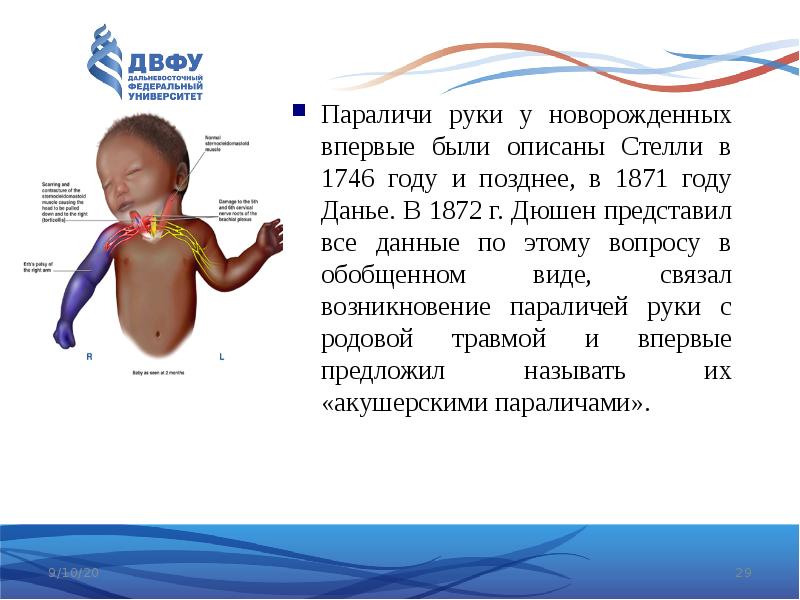 Парез дюшена эрба это. Для акушерского пареза руки типа Дюшенна Эрба характерно тест. Характеристика на ребенка с диагнозом парез Эрба Дюшена.