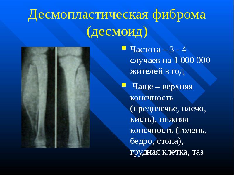 Доброкачественные опухоли костей презентация