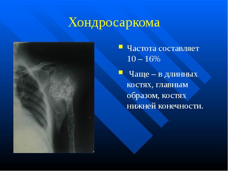 Опухоли костей презентация