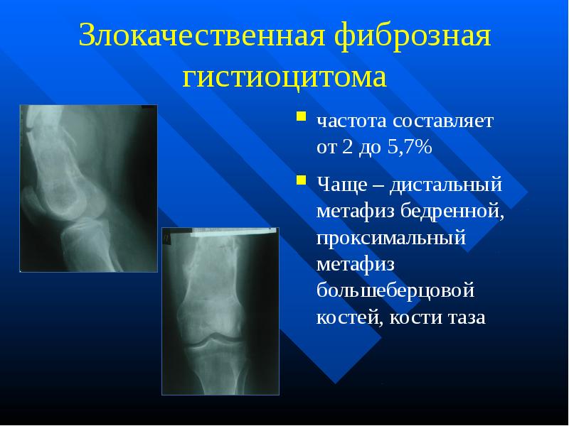 Злокачественные опухоли костей презентация