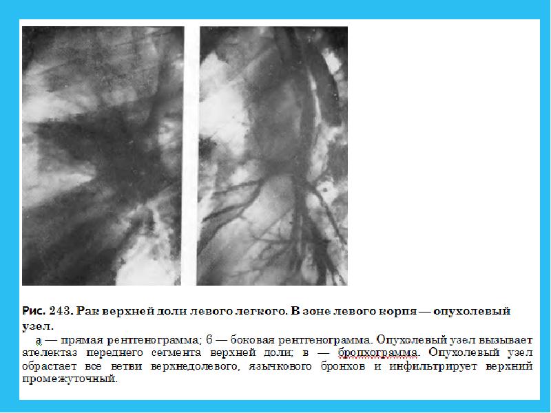 Рак легкого презентация