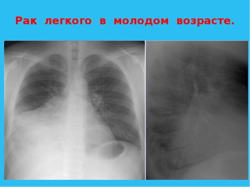 Возраст легких. Онкология легкого 4 степень. Онкология легких 4 стадия. Центральный с-г правого легкого 4 стадия.