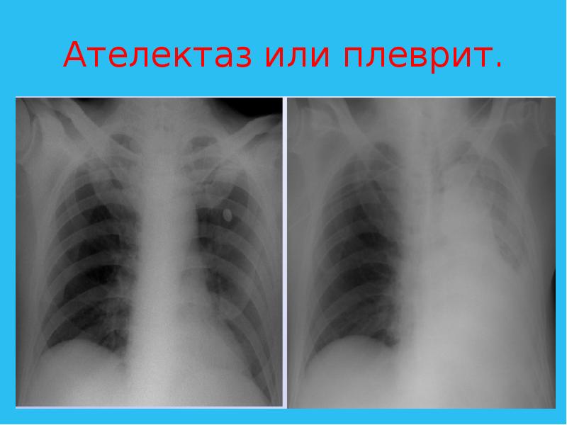 Ателектаз легкого на рентгеновском снимке фото