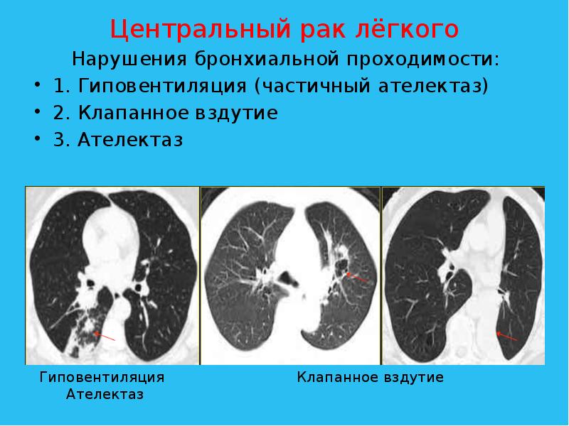 Кт легких презентация