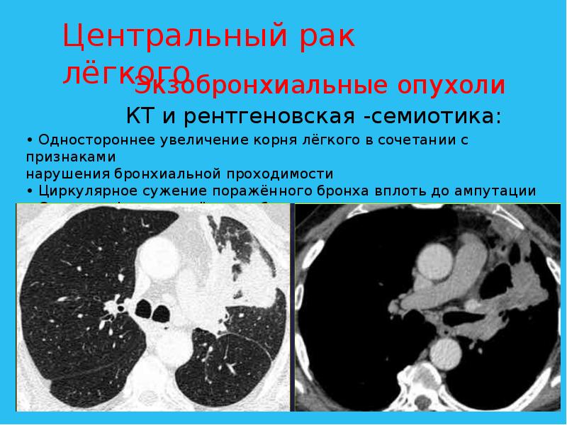 Рак легкого презентация онкология