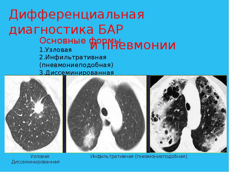 Бронхоальвеолярный рак презентация