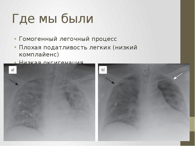 Ниже легких. Податливость легких. Податливость легких норма. Податливость лёгких что это. Податливость легких может быть определена.