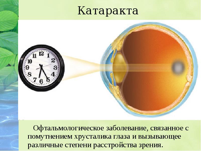 Заболевания глаз биология 8. Строение глаза катаракта. Катаракта строение. Катаракта схема глаза. Зрение -15.