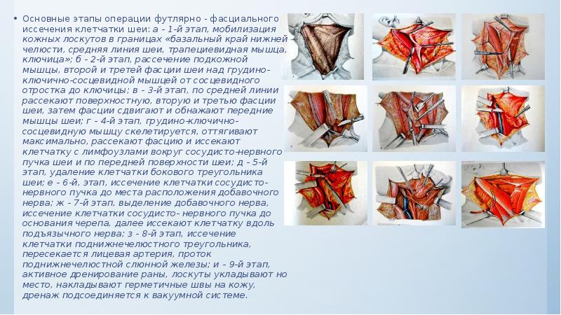 Основные этапы операции футлярно - фасциального иссечения клетчатки шеи: а -