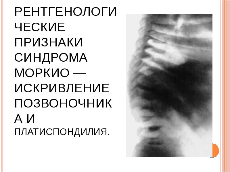 Рентгенологические признаки синдрома Моркио — искривление позвоночника и платиспондилия. Рентгенологические признаки синдрома Моркио — искривление позвоночника и платиспондилия.