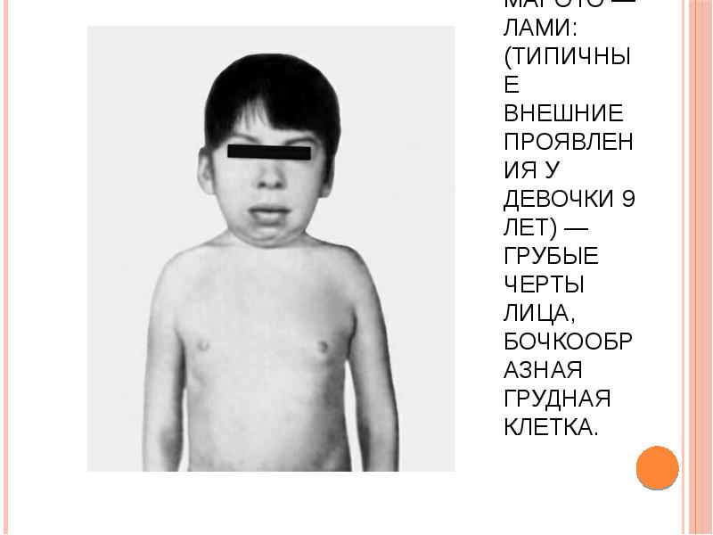 Синдром Марото — Лами: (типичные внешние проявления у девочки 9 лет) — грубые Синдром Марото — Лами: (типичные внешние проявления у девочки 9 лет) — грубые