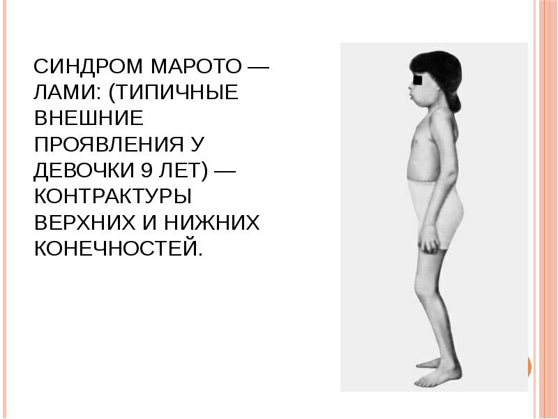 Синдром Марото — Лами: (типичные внешние проявления у девочки 9 лет) — контрактуры Синдром Марото — Лами: (типичные внешние проявления у девочки 9 лет) — контрактуры