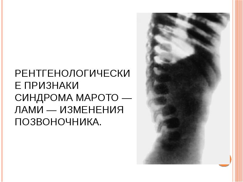 Рентгенологические признаки синдрома Марото — Лами — изменения позвоночника. Рентгенологические признаки синдрома Марото — Лами — изменения позвоночника.