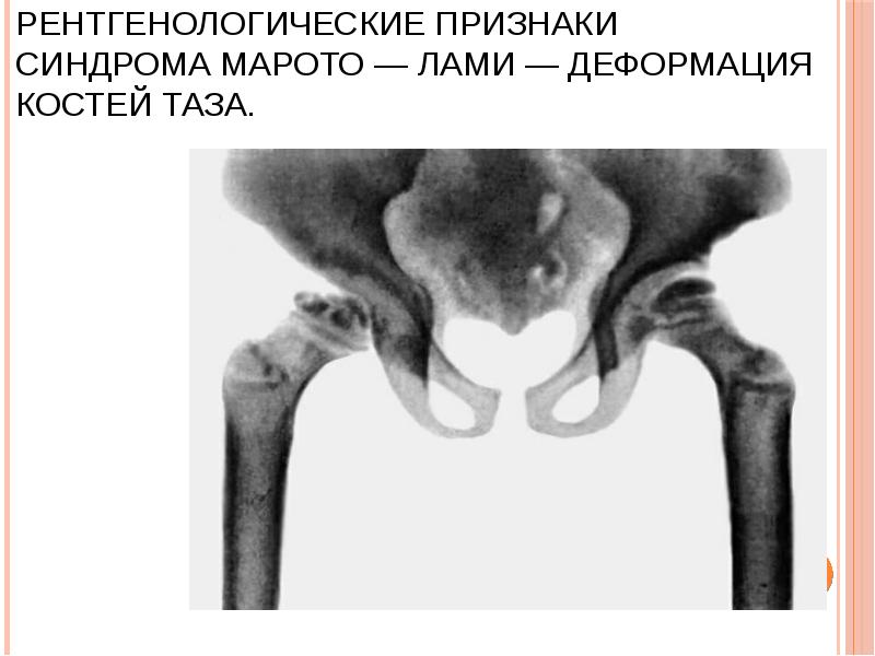 Рентгенологические признаки синдрома Марото — Лами — деформация костей таза. Рентгенологические признаки синдрома Марото — Лами — деформация костей таза.
