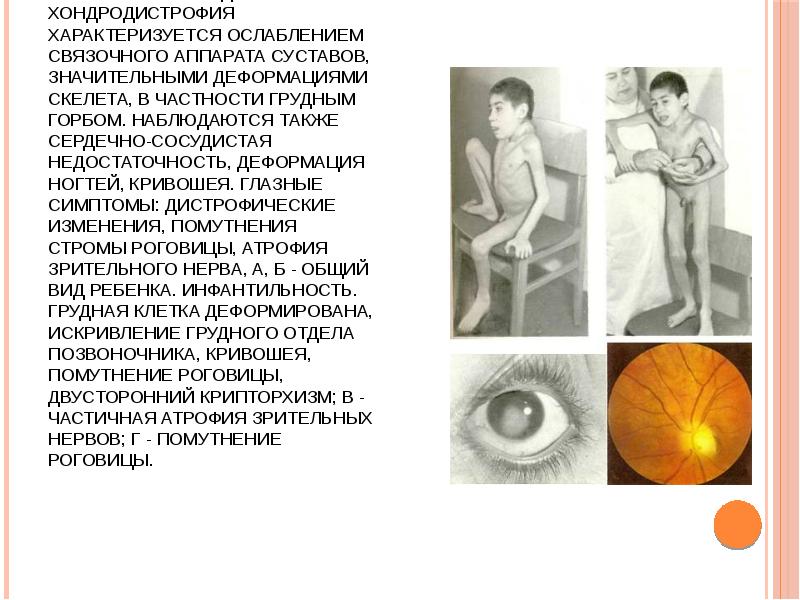 Синдром Моркио-Улльриха. Генетически детерминированное заболевание - мукополисахаридоз - IV. Хондродистрофия характеризуется Синдром Моркио-Улльриха. Генетически детерминированное заболевание - мукополисахаридоз - IV. Хондродистрофия характеризуется