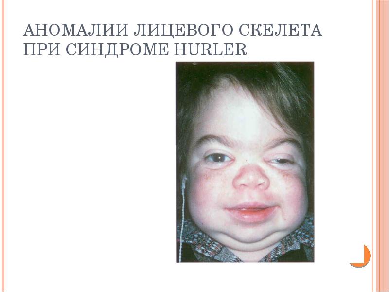 Аномалии лицевого скелета при синдроме Hurler Аномалии лицевого скелета при синдроме Hurler