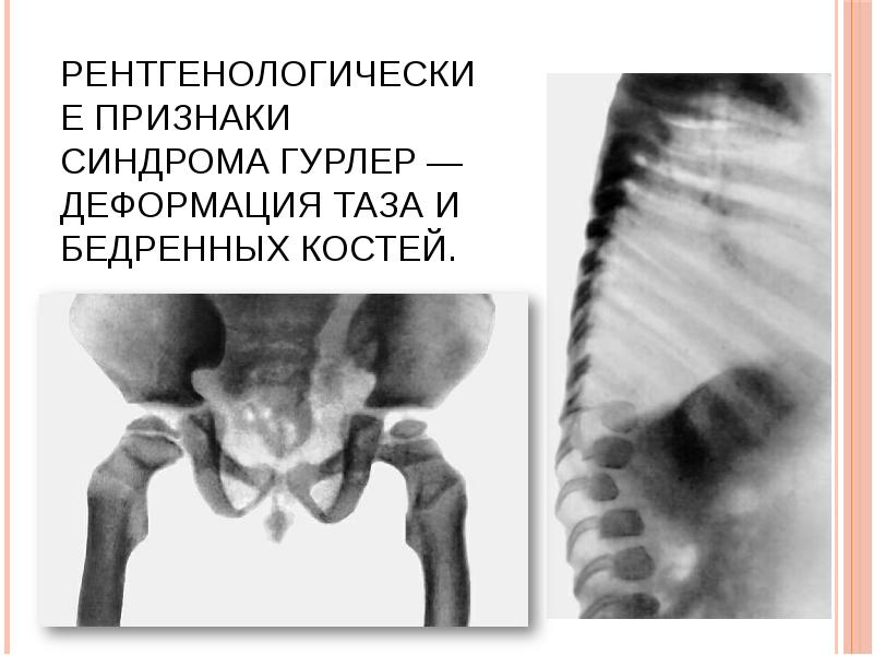 Рентгенологические признаки синдрома Гурлер — деформация таза и бедренных костей. Рентгенологические признаки синдрома Гурлер — деформация таза и бедренных костей.