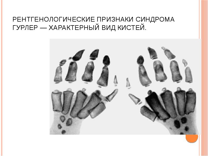 Рентгенологические признаки синдрома Гурлер — характерный вид кистей. Рентгенологические признаки синдрома Гурлер — характерный вид кистей.