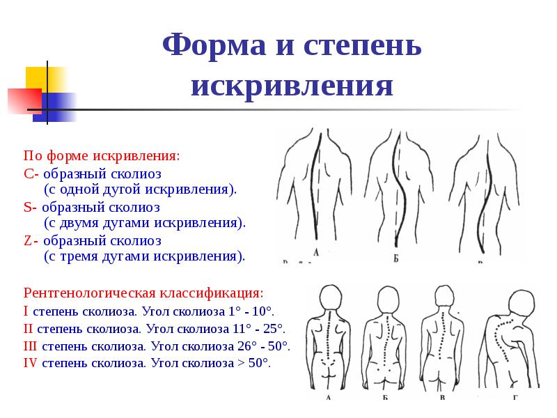 Первые стадии. S – образное искривление позвоночника степени. Z образный сколиоз 1 степени. S образное искривление позвоночника 2 степени. S образный сколиоз 2 степени.