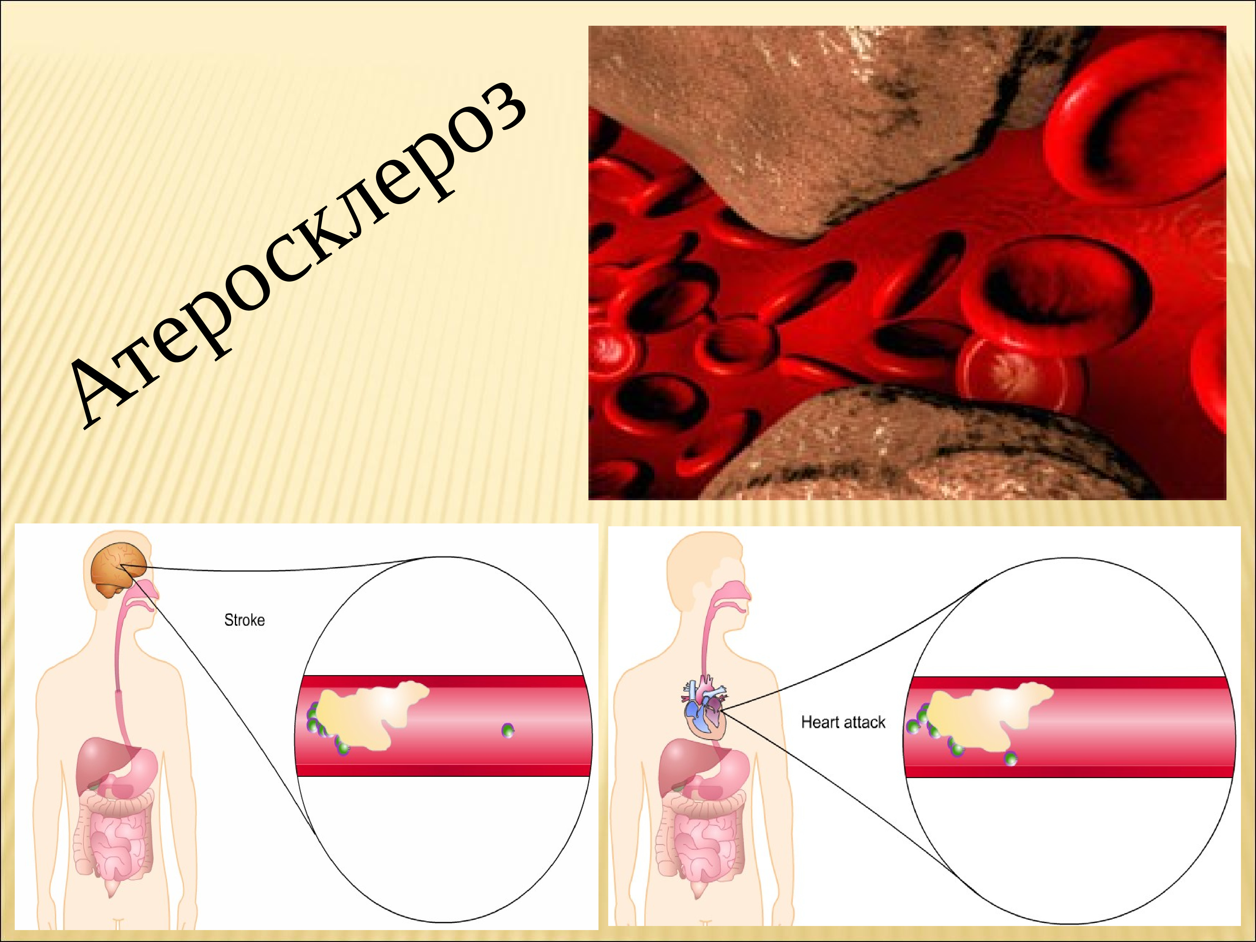 Атеросклероз и Свободный кальций. Атеросклероз история открытия.