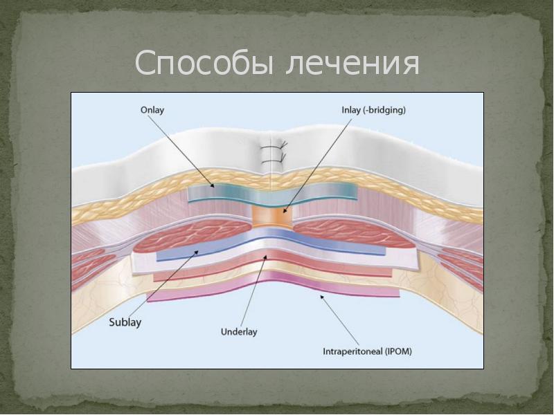 Стенки грыжи. Вентральные грыжи. Пластика in Lei sub Lei. Пластика передней брюшной стенки sublay.