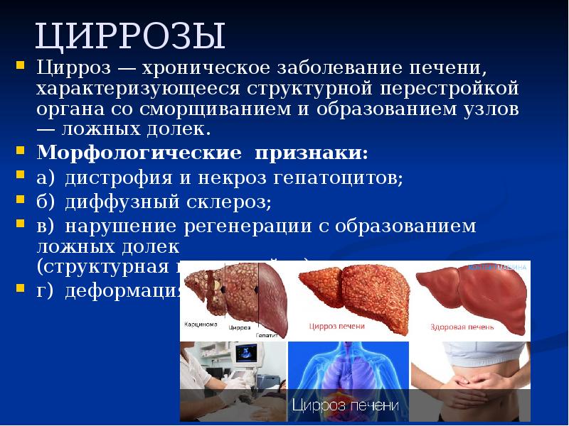 ЦИРРОЗЫ
Цирроз — хроническое заболевание печени, характеризующееся структурной перестройкой органа со ЦИРРОЗЫ
Цирроз — хроническое заболевание печени, характеризующееся структурной перестройкой органа со