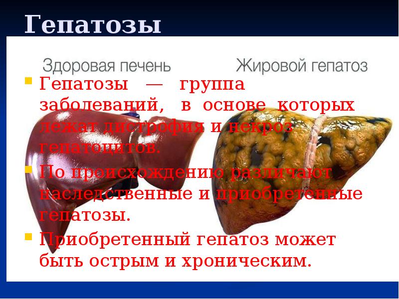 Гепатозы
Гепатозы — группа заболеваний, в основе которых Гепатозы
Гепатозы — группа заболеваний, в основе которых