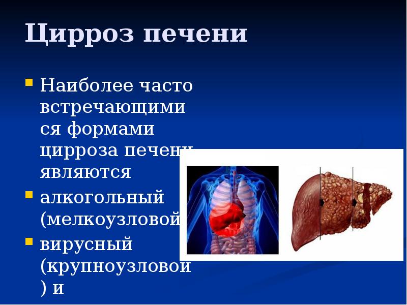 Цирроз печени
Наиболее часто встречающимися формами цирроза печени являются
алкогольный Цирроз печени
Наиболее часто встречающимися формами цирроза печени являются
алкогольный